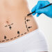 liposuction surgery in India