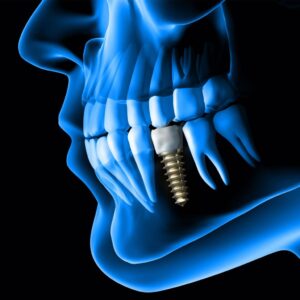 Affordable Dental Implants in the UAE