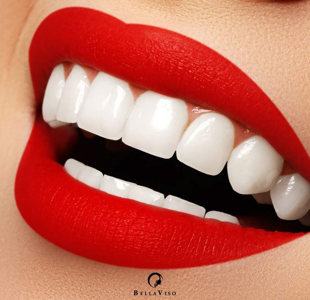 Best Dental Veneers Treatment in Dubai
