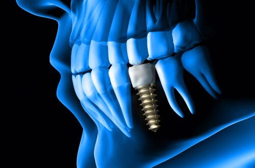 Best Dental Implants Treatment in Dubai