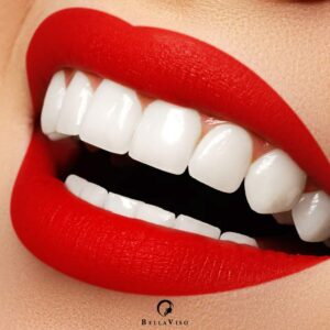 Top Rated Dental Veneers Clinic in Dubai