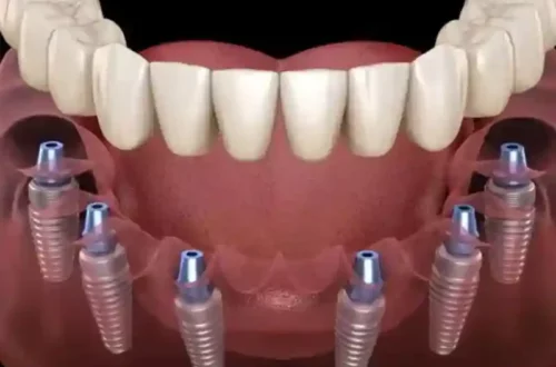 Houston Dental Implants