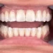 West Houston Dental Implants